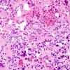 5B5 Pineocytoma (Case 5) H&E 7.jpg