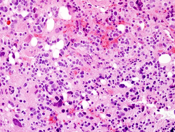 5B5 Pineocytoma (Case 5) H&E 7.jpg