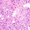 5B6 Pineocytoma (Case 5) H&E 8.jpg