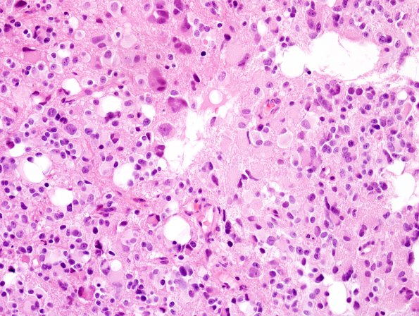 5B6 Pineocytoma (Case 5) H&E 8.jpg