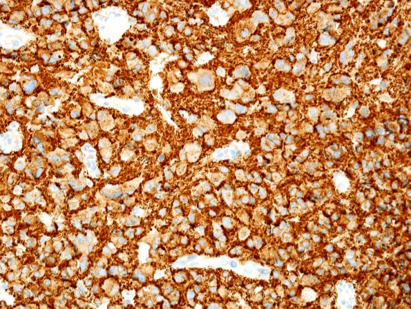 5C1 Pineocytoma (Case 5) SYN 2.jpg