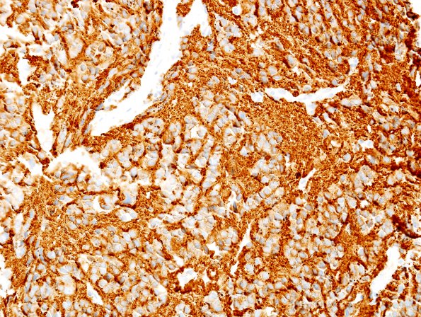 5C2 Pineocytoma (Case 5) SYN 6.jpg