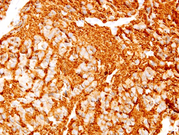 5C3 Pineocytoma (Case 5) SYN 7.jpg