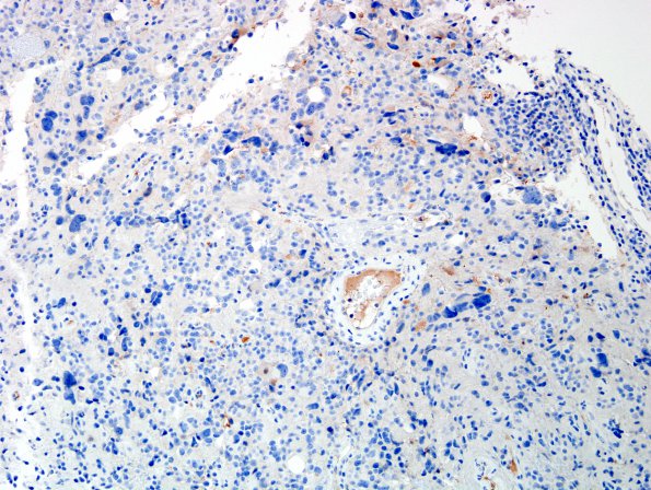 5D Pineocytoma (Case 5) NeuN 1.jpg