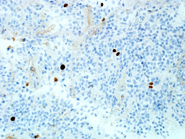 5E Pineocytoma (Case 5) Ki67 1.jpg