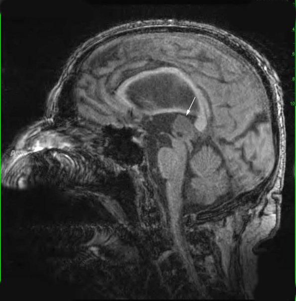 6A1 Pineocytoma, Gr 2 (Case 6) T1 MPRAGE copy