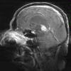 6A2 Pineocytoma (Case 6) T1 POST-CONTRAST - Copy