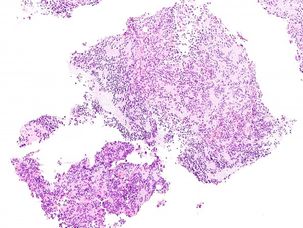 6B1 Pineocytoma (Case 6) H&E 7.jpg