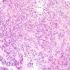 6B2 Pineocytoma (Case 6) H&E 8.jpg