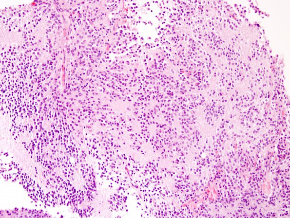 6B2 Pineocytoma (Case 6) H&E 8.jpg