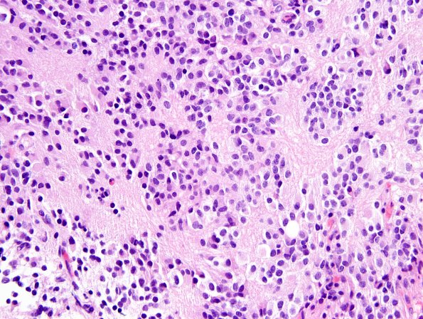 6B3 Pineocytoma (Case 6) H&E_1A.jpg