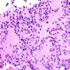 6B4 Pineocytoma (Case 6) H&E_4a.jpg