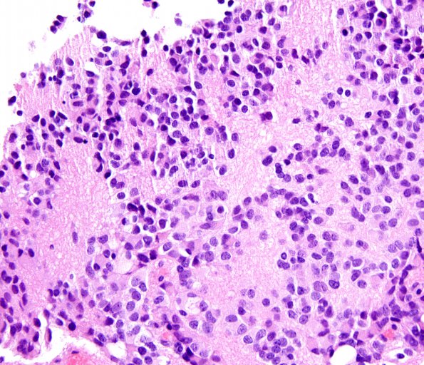 6B4 Pineocytoma (Case 6) H&E_4a.jpg