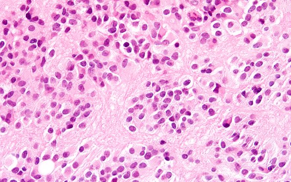 6B5 Pineocytoma (Case 6) H&E 60X