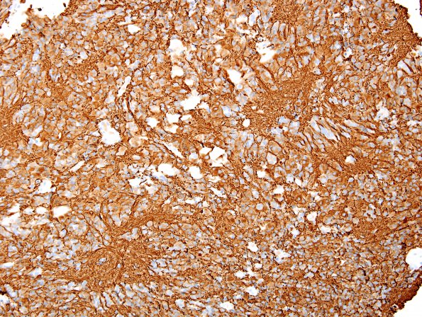 6C1 Pineocytoma (Case 6) NF 8.jpg