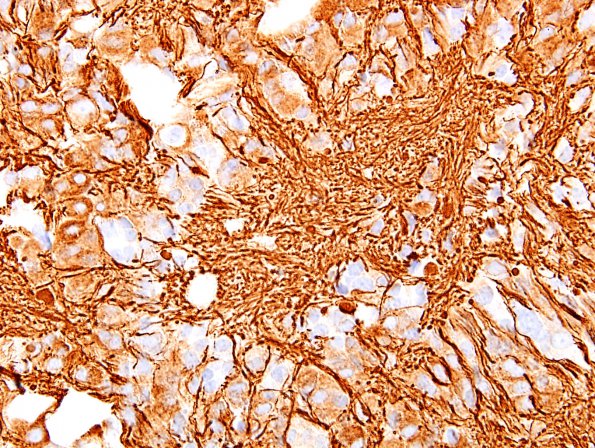 6C2 Pineocytoma (Case 6) NF 1