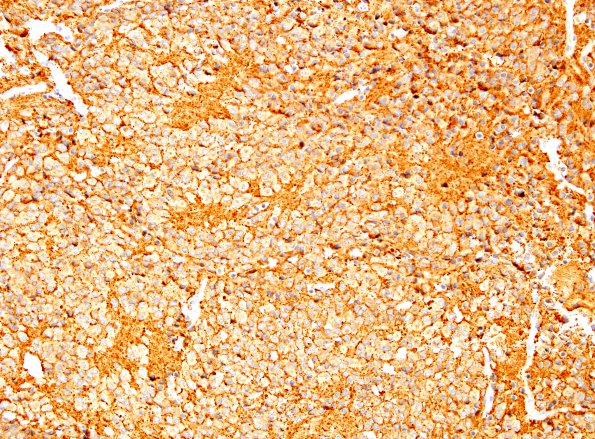 6D1 Pineocytoma (Case 6) SYN 8.jpg