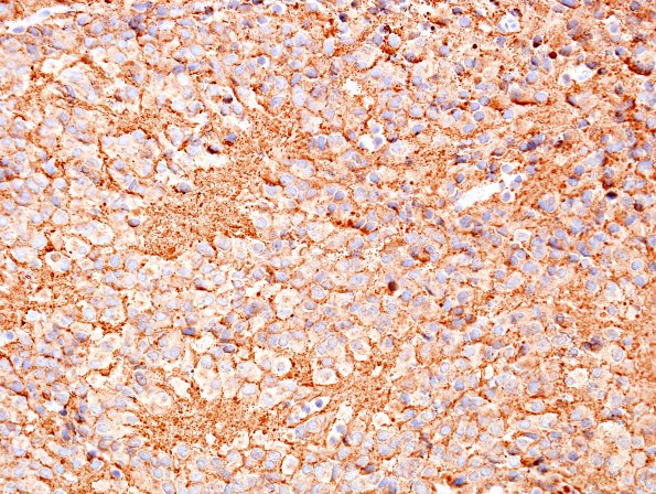 6D2 Pineocytoma (Case 6) SYN 7.jpg