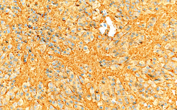 6D3 Pineocytoma (Case 6) SYN 40X