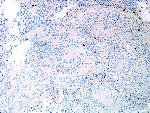 6E Pineocytoma (Case 6) Ki67 3.jpg