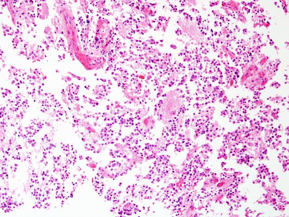 7A1 Pineocytoma (Case 7) H&E 2.jpg