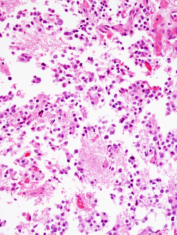 7A2 Pineocytoma (Case 7) H&E 1.jpg