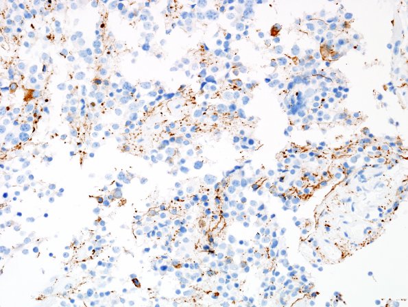 7B1 Pineocytoma (Case 7) NF 1.jpg