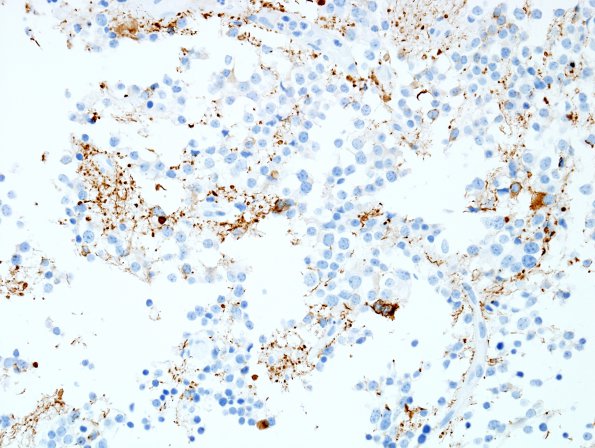 7B2 Pineocytoma (Case 7) NF 4.jpg