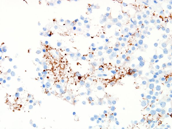 7B3 Pineocytoma (Case 7) NF 3.jpg