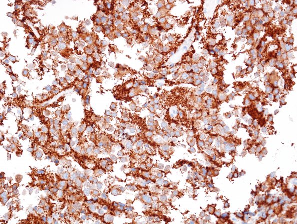 7C2 Pineocytoma (Case 7) SYN 2.jpg