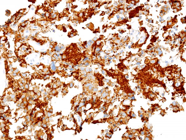 7C3 Pineocytoma (Case 7) SYN 1.jpg