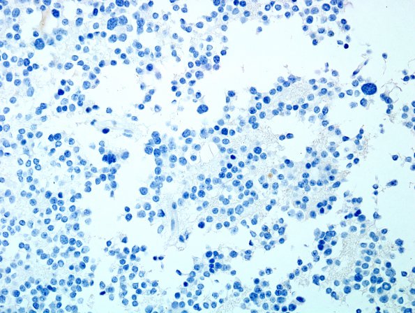 7D Pineocytoma (Case 7) NeuN.jpg