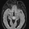 8A1 Pineocytoma (Case 8) FLAIR - Copy