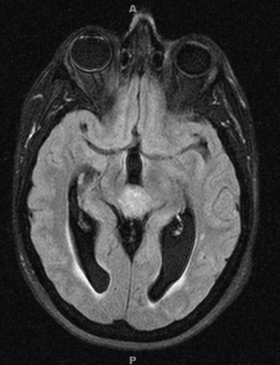 8A1 Pineocytoma (Case 8) FLAIR - Copy