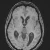 8A2 Pineocytoma (Case 8) T1 1 - Copy