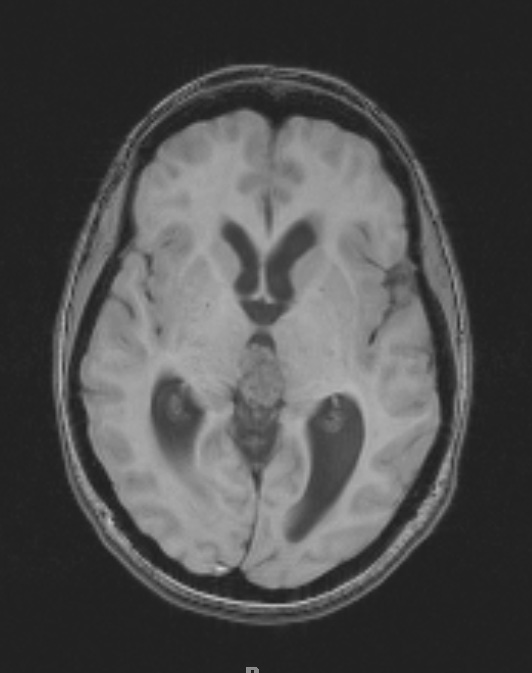 8A2 Pineocytoma (Case 8) T1 1 - Copy