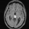 8A3 Pineocytoma (Case 8) T1 W3 - Copy