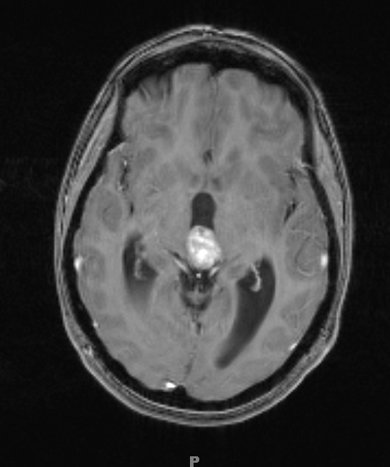 8A3 Pineocytoma (Case 8) T1 W3 - Copy