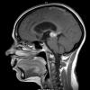 8A4 Pineocytoma (Case 8) T1 W4 - Copy