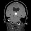 8A5 Pineocytoma (Case 8) T1 W6 - Copy