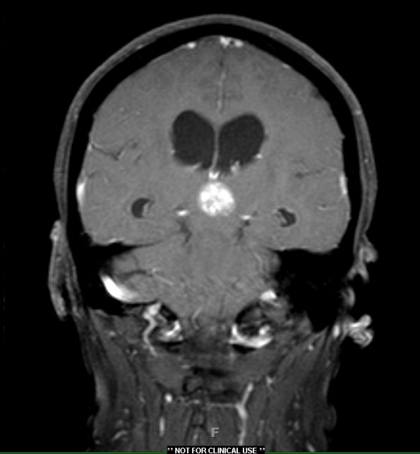 8A5 Pineocytoma (Case 8) T1 W6 - Copy