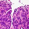 8B1 Pineocytoma (Case 8) H&E 1.jpg