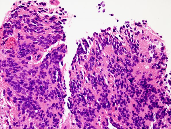 8B1 Pineocytoma (Case 8) H&E 1.jpg