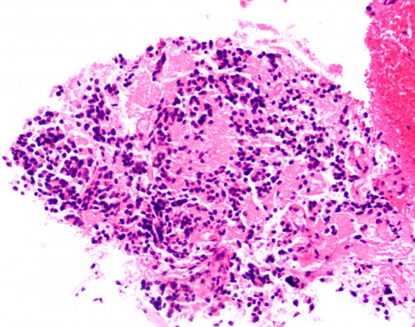 8B2 Pineocytoma (Case 8) H&E 20X