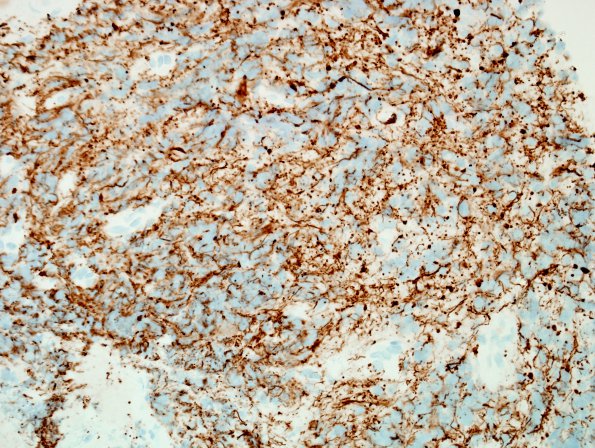 8C1 Pineocytoma (Case 8) NF 1.jpg