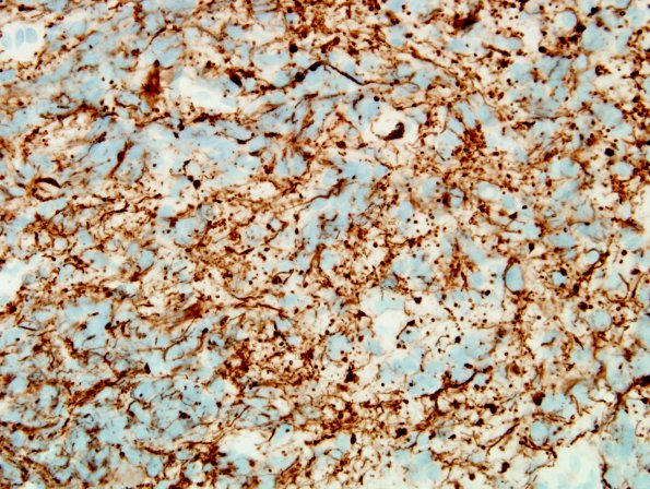 8C2 Pineocytoma (Case 8) NF 2.jpg