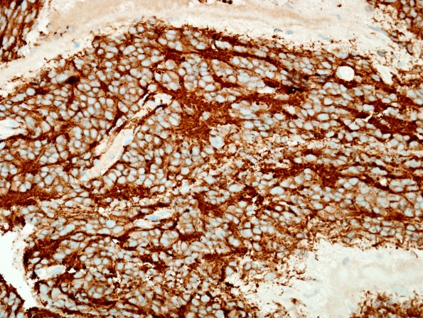 8D2 Pineocytoma (Case 8) SYN 3.jpg