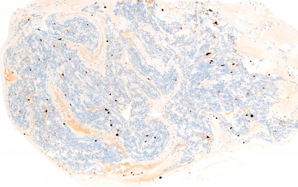 8E Pineocytoma (Case 8) Ki67 10X