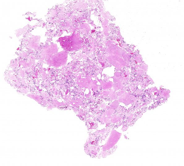 9A1 Pineocytoma w neuronal diffn (Case 9) H&E whole mount