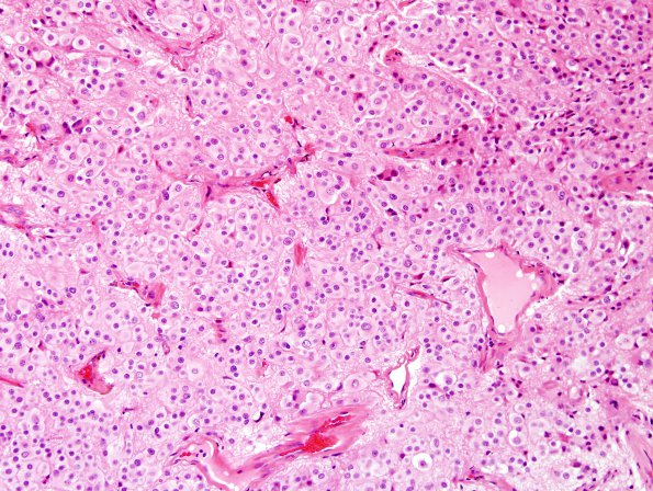 9A2 Pineocytoma w neuronal diffn (Case 9) H&E 1.jpg